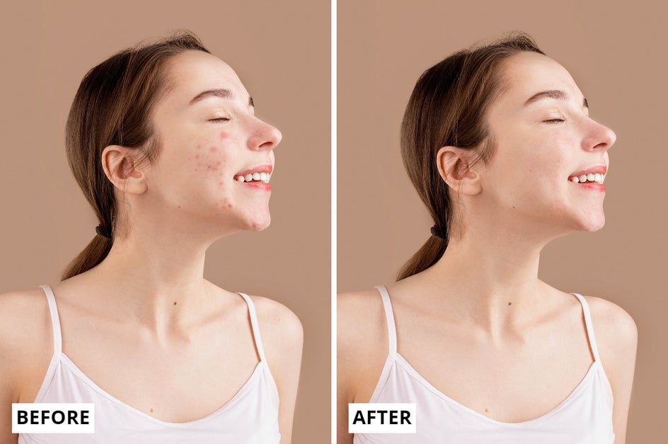 Blemish Remover Tool Before and After